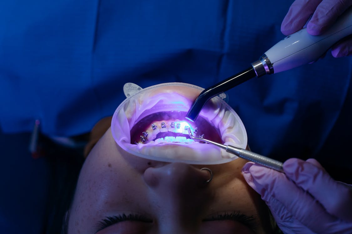 Lente de Contato Dental